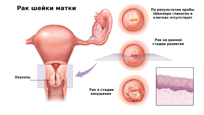 Кольпит или вагинит – воспаление влагалища