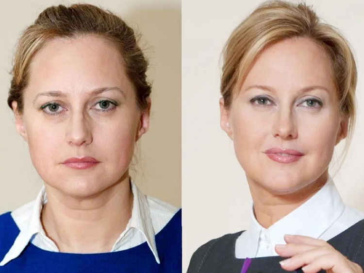 Угол молодости на лице фото до и после филлеры